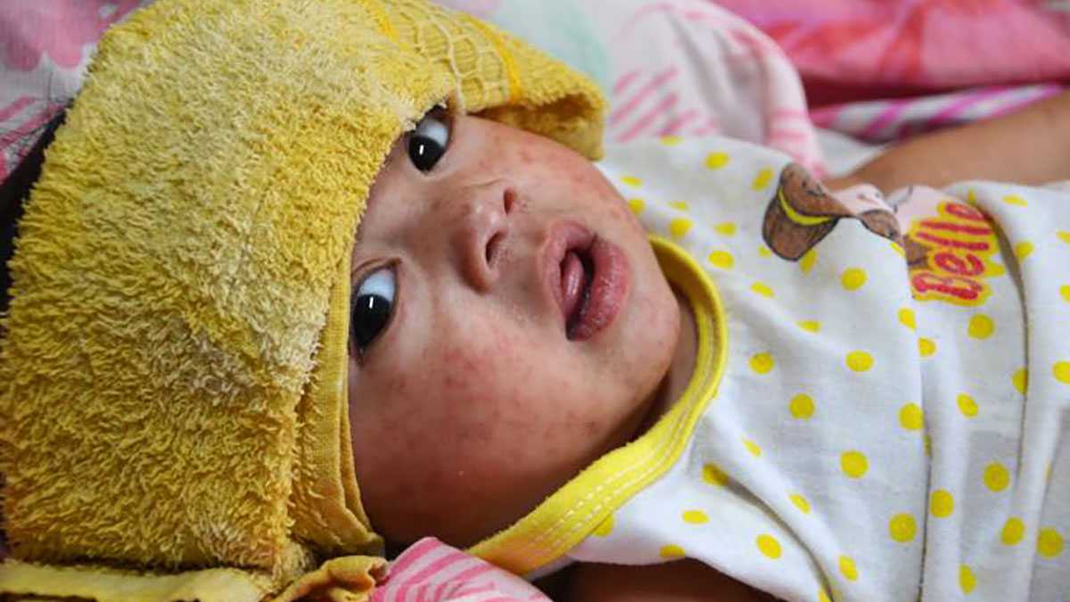 Baby with Measles - Copy